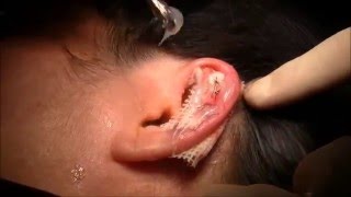 立ち耳手術例 Otoplasty for Protruding ear (Prominent ear)