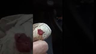 THE MOHEL CIRCUMCISED MY FINGER