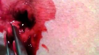 MAI~2 navel pierce cut bleed pt2