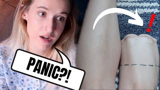 6 Days Before Amputation AGAIN - Making PEACE with PANIC...