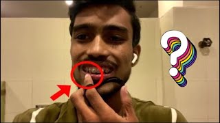 My 2nd stage teeth braces treatment