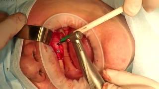 Клинический случай  Bio3 Implants : имплантация на беззубой челюсти