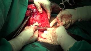 22 Weeks fibroid Uterus, Abdominal Hysterectomy Part - I (Rama Hospital)