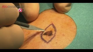 Mélanome : l'exérèse des grains de beauté suspects - Allô Docteurs