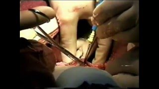 TRASPLANTE EXPERIMENTAL
