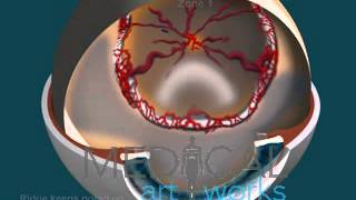 3D Medical Animation | 5 Stages ROP