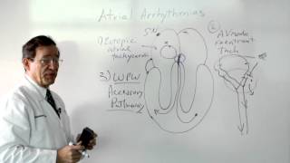 Wolff Parkinson White Syndrome - WPW
