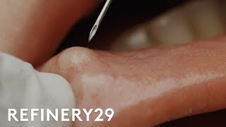 I Got My Botched Lip Filler Popped | Macro Beauty | Refinery29