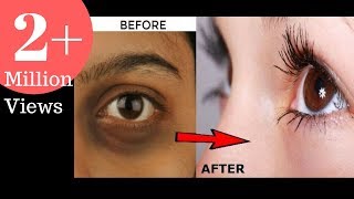 एक ही बार के यूज़ में आपके आंखों के काले घेरे को खत्म करके दुनिया के सबसे सुंदर चेहरा बना देगा eye