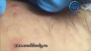 Шугаринг обучение Мастер класс Удаление вросших волос Removing ingrown hairs Токмаков