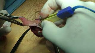 CIRUGIA CIRCUNCISION