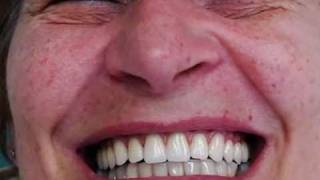 CARGA IMEDIATA EM PORCELANA - DENTADURA FIXA - IMPLANTE CURITIBA