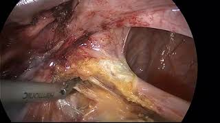 deep infiltrative endometriosis of the pelvic floor rectum and vagina. Radical excision