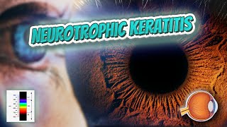 Neurotrophic keratitis - Your EYEBALLS - EYNTK ?️?️?????✅