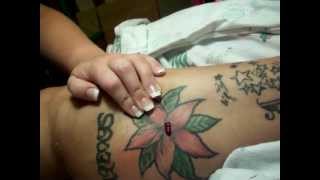 Sabaceous Cyst