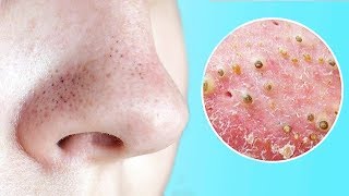 КАК ИЗБАВИТЬСЯ ОТ ЧЕРНЫХ ТОЧЕК? ???