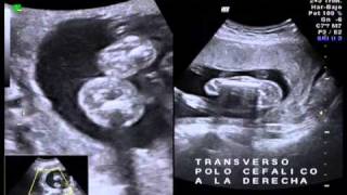 ecografia niño o niña?