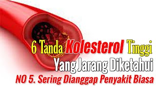 WASPADA!!! INILAH TANDA-TANDA KOLESTEROL TINGGI YANG WAJIB DIKETAHUI