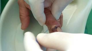 FINGER ABSCESS AFTER MANICURE/Панариций.Осложнение маникюра.