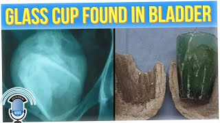 Woman's UTI Turns Out to be Glass Tumbler in Her Bladder?! (ft. Don Tran)