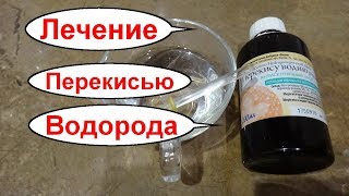 Лечение гастрита и язвы желудка перекисью водорода. Как принимать перекись водорода внутрь