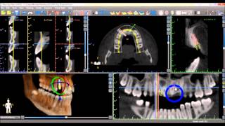 Blue Sky Plan 3 Tutorial: Placing Implants