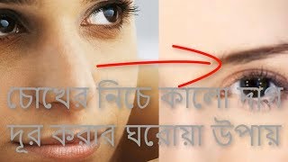 চোখের নিচে কালো দাগ দূর করার ঘরোয়া উপায়, The domestic way to remove black spots under the eyes