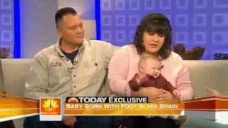Miracle Baby; born with foot in brain