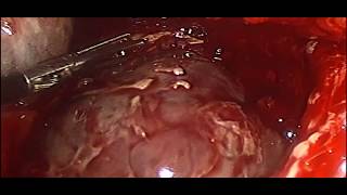 Parasitic Dermoid Cyst in POD Laparoscopic Management د لؤي أبوعتيله و علاج كيس عجائبي نادر بالمنظار