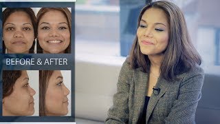Rhinoplasty Surgery | Before and After | Dr. Cory Torgerson