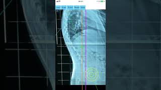 How to measure with Sagittal Balance App iOS