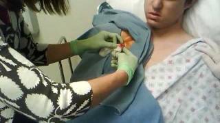 Dialysis Catheter Removel