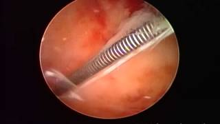 IUD EXTRACTION