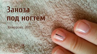 РИЦИНИОЛ отзыв заноза под ногтем Кемерово 2011