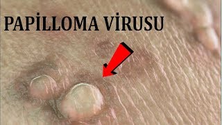Cinsiyyət yolunda ziyillər - xərçəngə çevrilə bilərmi?