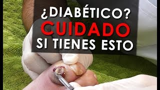 ¿Callo o úlcera de pie diabético? Pacientes reales