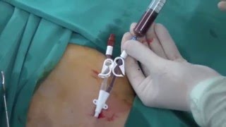 Permanent HD Cath insertion