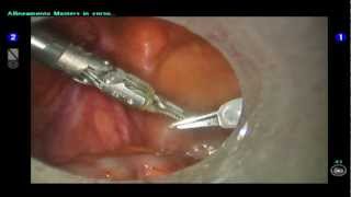 PROSTATECTOMIA RADICALE ROBOTICA