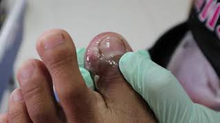 Ep_495 Ingrown nail removal ? โอ๊ยผมขาสั่นเลย ลุ้นจนพี่เหงื่อแตก  (^_^)'
