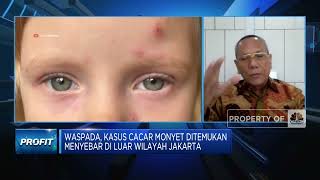 Kemenkes Deteksi 24 Kasus Cacar Monyet RI, Waspada Gejalanya!