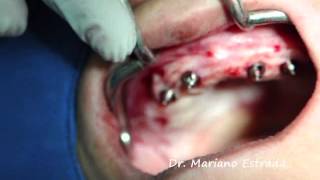 Computer guided surgery  with Inmediate loading