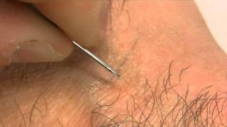 How to remove an ingrown hair