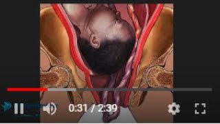 Prolapsed Umbilical Cord - Obstetric Emergency - Archer NCLEX Qbank and Reviews