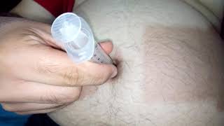 Needle in navel