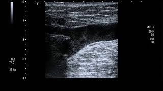 incompetent saphenofemoral valve on grey scale (RFA)