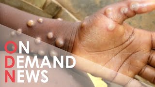 Monkeypox: EVERYTHING You Need to Know About New Virus