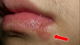 「嘴唇起泡」好難受！把它塗在患處, 隔天迅速見效！