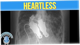 World's First Heartless Human Was Able to Live Without a Pulse