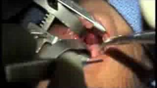 Patent Ductus Arteriusus (PDA) performed on Premature Baby - Pediatric Heart Surgery