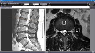 Severe Foot Drop: the Clinical & MRI Findings of a Real Client with a Surprise Finding